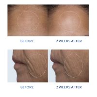 Bloomeffects Black Tulip Facial Treatment Before And After